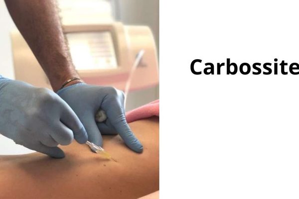 Carbossiterapia per la cellulite